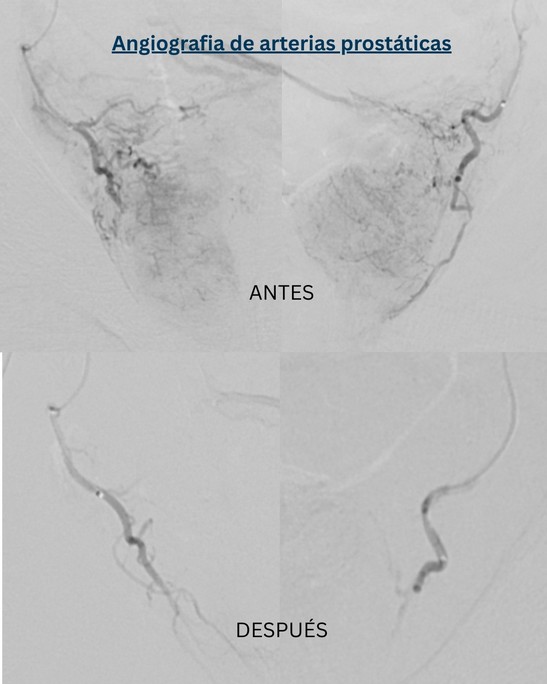 Angiografía de arterias prostáticas antes y después de la embolización