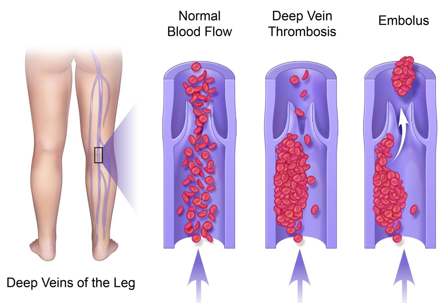 Diagrama del procedimiento — Trombosis Venosa Profunda (DVT)