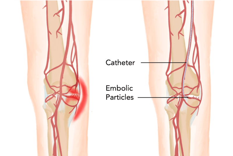 Diagrama del procedimiento — Embolización para Artritis de Rodilla (GAE)