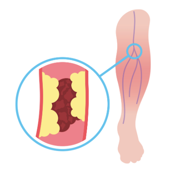 Diagrama del procedimiento: Enfermedad Arterial Periférica (PAD)
