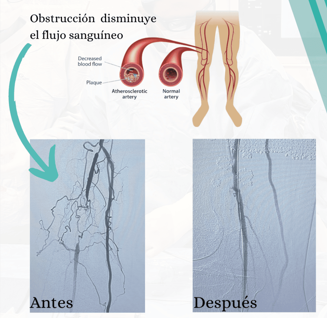 Enfermedad Arterial Periférica (PAD)
