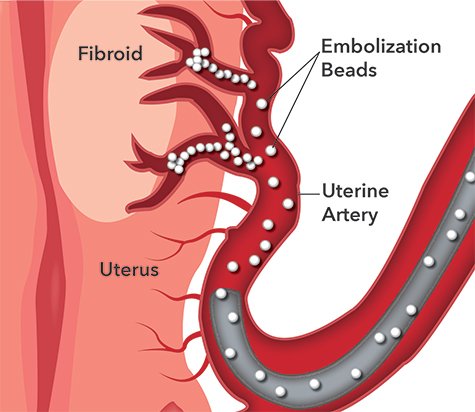Diagrama del procedimiento — Embolización de Fibromas Uterinos (UFE)