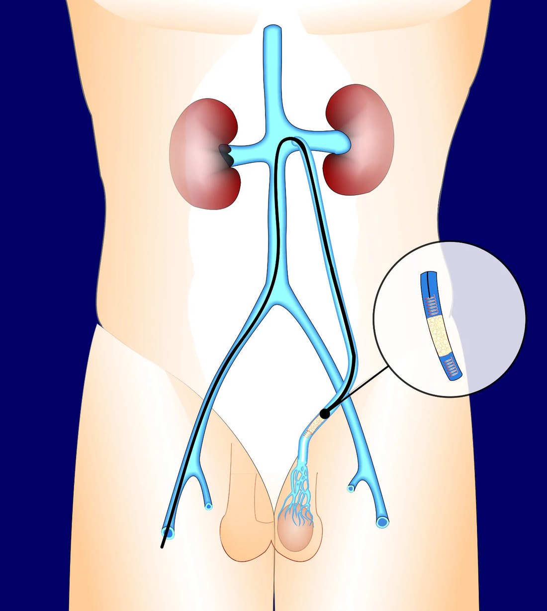 Diagrama del procedimiento — Embolización de Varicocele